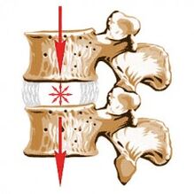 Zariadenie chrbtice a príčiny osteochondrózy