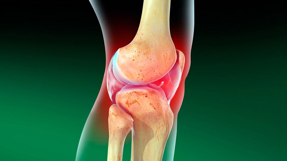 Osteoartróza kolenného kĺbu